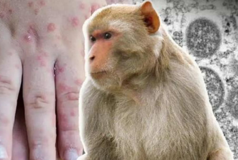 柬埔寨又发现猴痘病例 累计增至10例